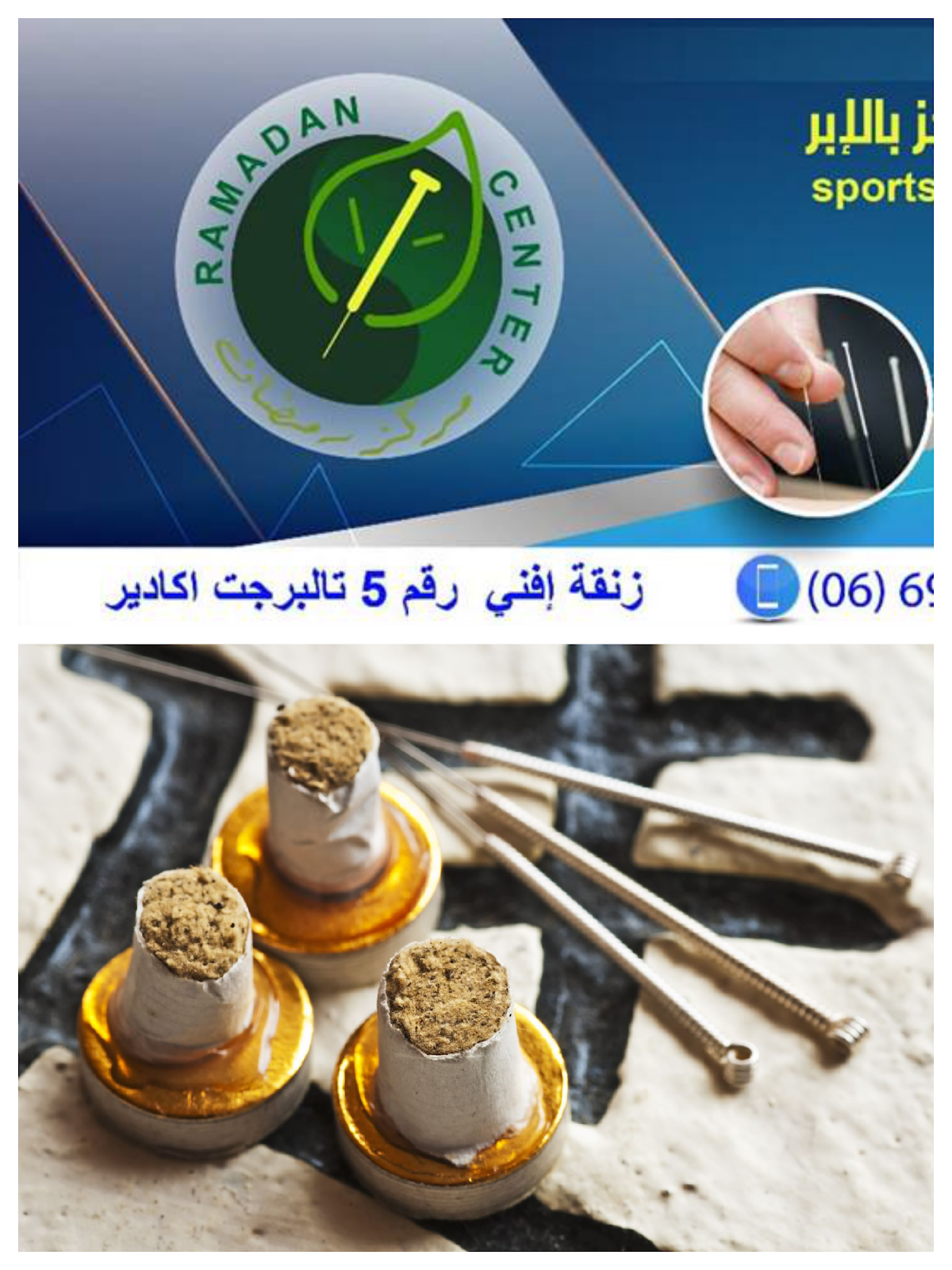 acupuncture الإبر الصينية